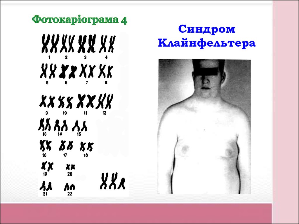 Синдром клайнфельтера наследственное. Трисомия синдром Клайнфельтера симптомы. Синдром Клайнфельтера 47 xxy. Синдром Клайнфельтера евнухоидное. Тип наследования Клайнфельтера.