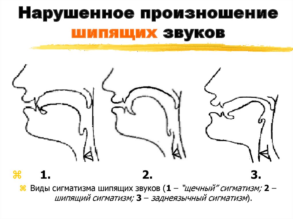 Произношение звуков. Носовой сигматизм шипящих звуков. Профили артикуляции шипящих звуков. Недостатки произношения шипящих звуков. Профили артикуляции звуков шипящие звуки.