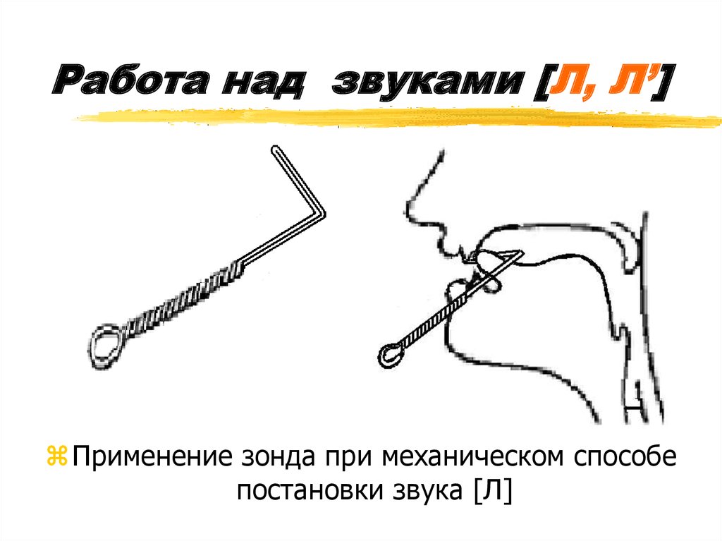 Способ л. Постановка звука л механическим способом зондом. Постановка звука л механической помощью с зондом. Постановка звука л с механической помощью. Постановка звука л с помощью зонда.