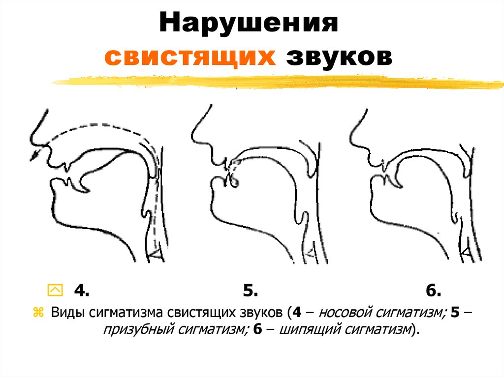 Нарушение артикуляционных схем отдельных звуков является первичным дефектом при какой афазии