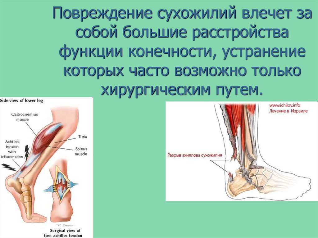 Растяжение сухожилия. Классификация сухожилий.