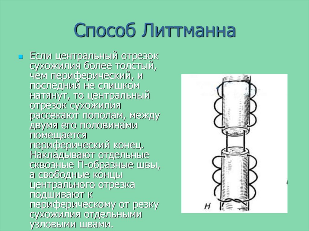 Способ. Шов Брауна сухожильный техника. Шов Литтмана сухожильный. Шов Баннелла сухожильный.