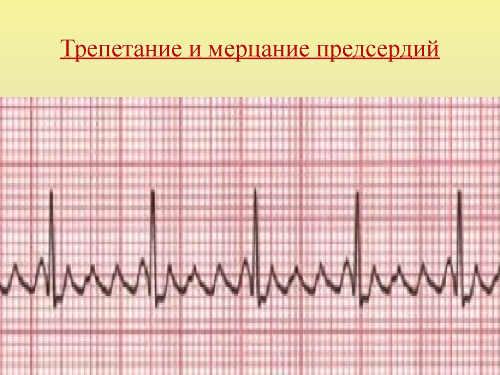 Мерцание предсердий на экг фото