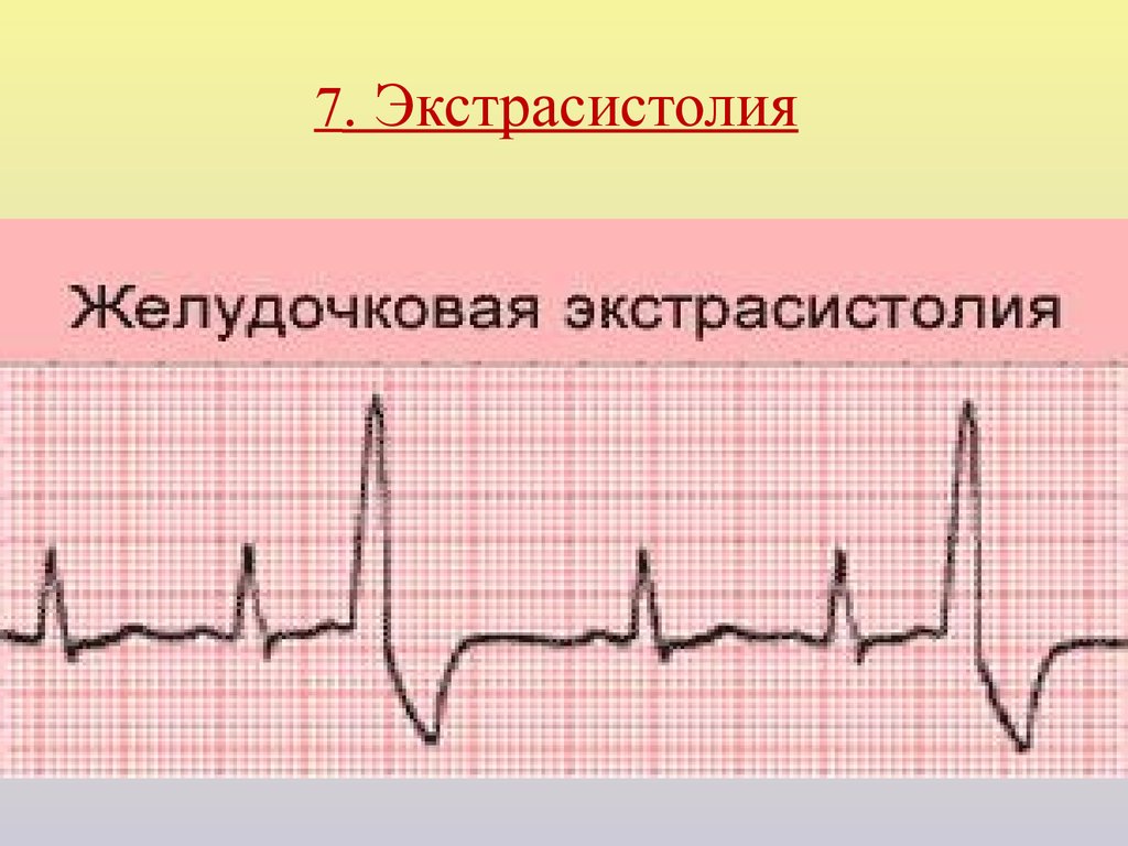 Типы желудочковых экстрасистол