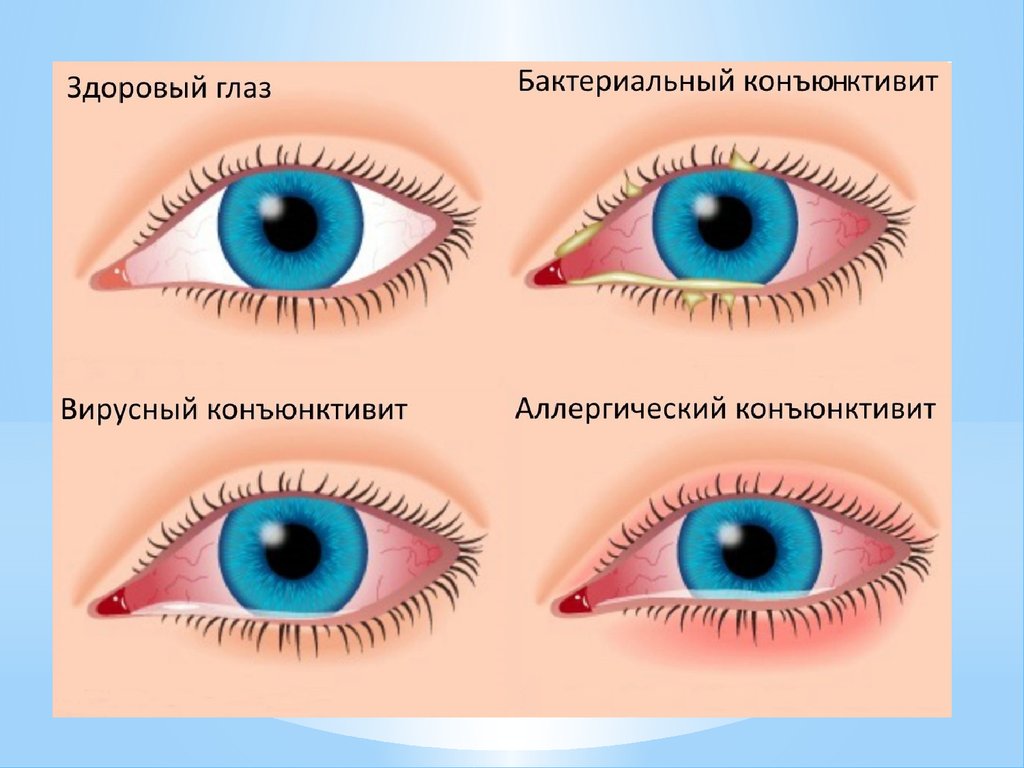 Орви и глаза. Осложнения конъюнктивита. Здоровые глаза. Глаза при вирусном конъюнктивите.