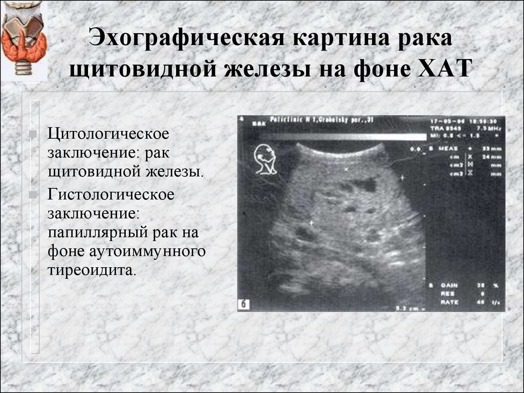 Злокачественные опухоли щитовидной железы презентация