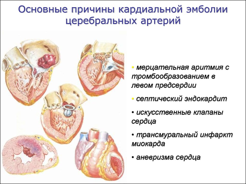 Трансмуральный инфаркт миокарда. Причины кардиальной эмболии. Мерцательная аритмия ишемический инсульт. При эмболии церебральных артерий. Трансмуральный инсульт.