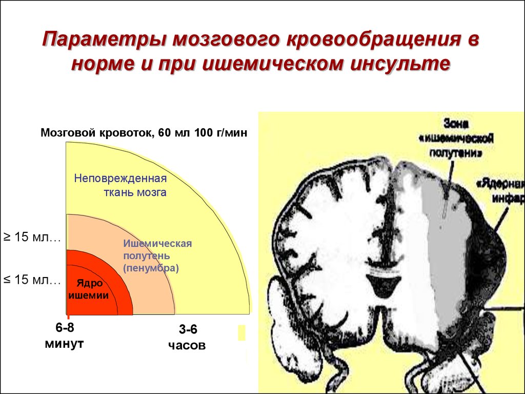 Ткань головного мозга. Ишемический инсульт зоны поражения головного мозга. Инсульт зоны поражения головного мозга. Пенумбра при ишемическом инсульте. Ишемический инсульт «ядро» ишемии.