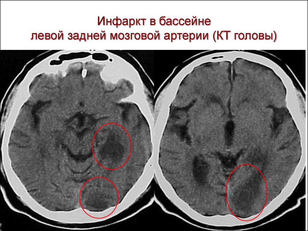 Инфаркт в бассейне левой задней мозговой артерии (КТ головы)