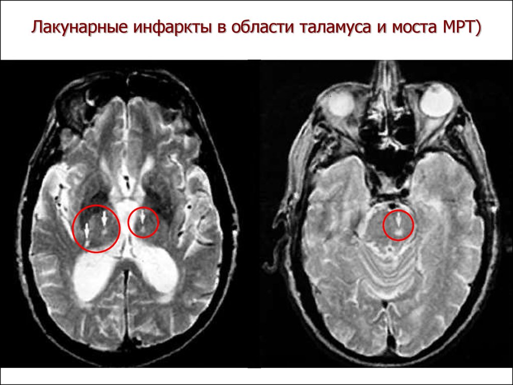 Ишемический инсульт головного мозга на мрт фото