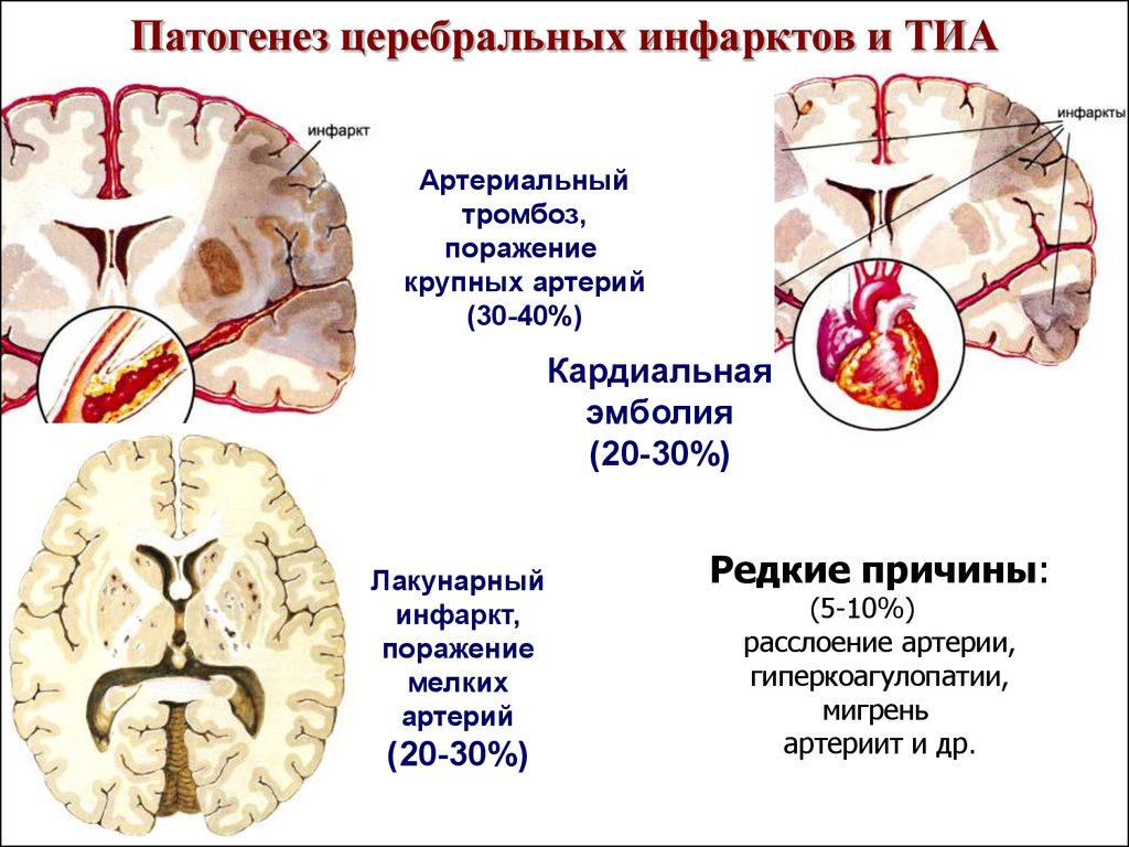 Патогенез церебральных инфарктов и ТИА