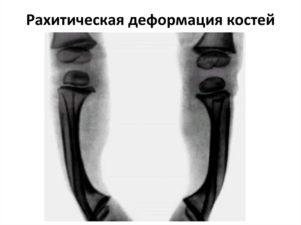 Деформация костей. Деформация костей скелета. Рахитическая деформация скелета.