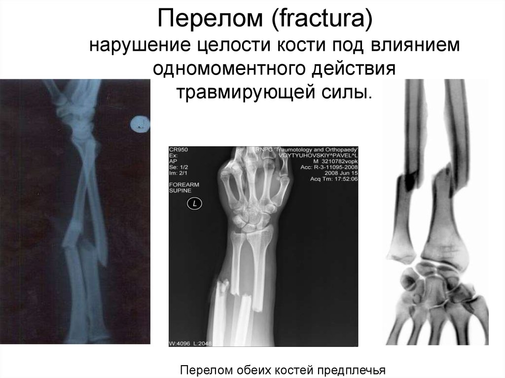 Перелом предплечья обе кости