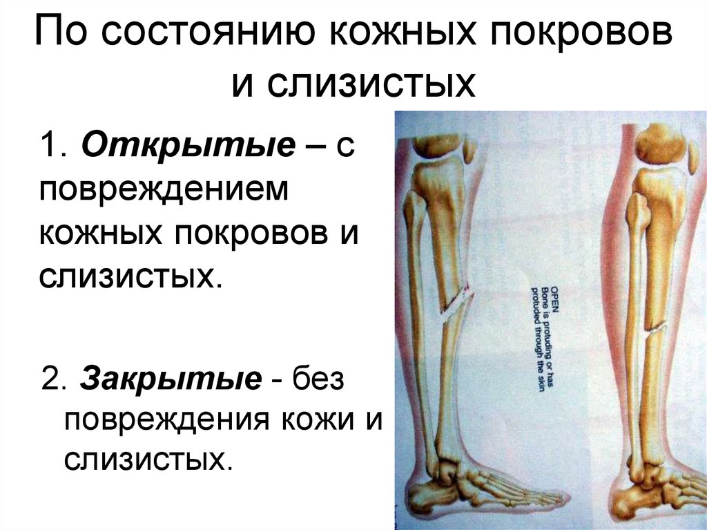 Возможное осложнение перелома. Осложненные переломы конечностей. Открытые и закрытые переломы травматология. Вывихи презентация травматология.