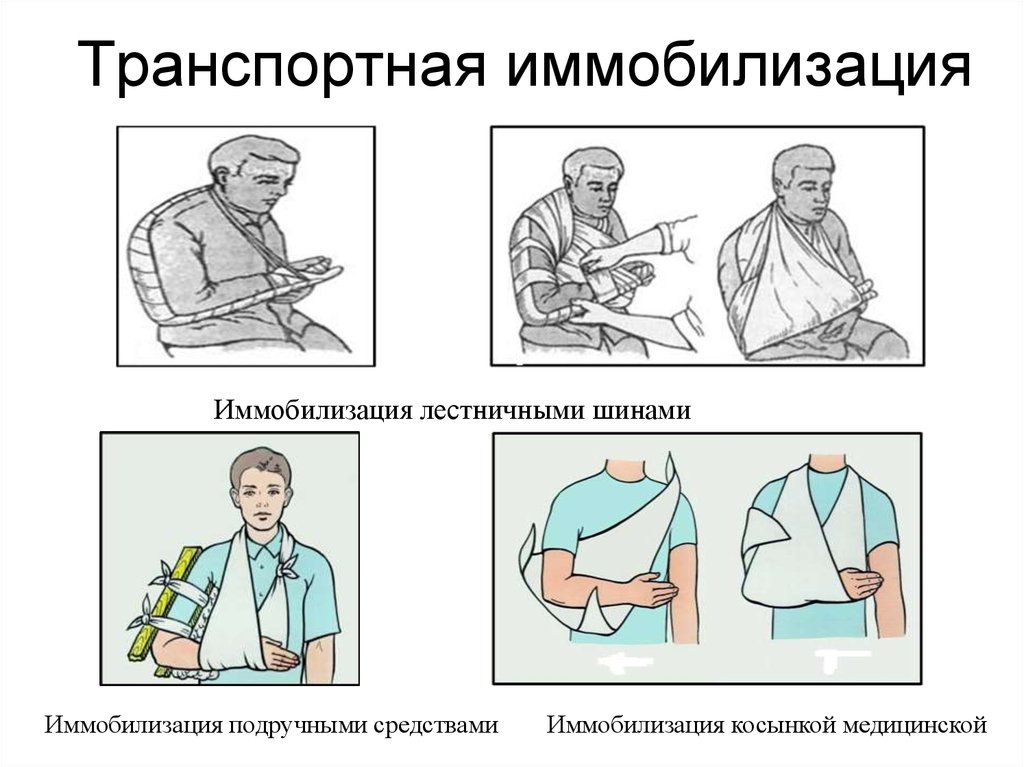 Транспортную иммобилизацию выполняют. Иммобилизация типы. Транспортная иммобилизация средства иммобилизации. Транспортная мобилизацация. Тоанспортнаяиммобилищация.