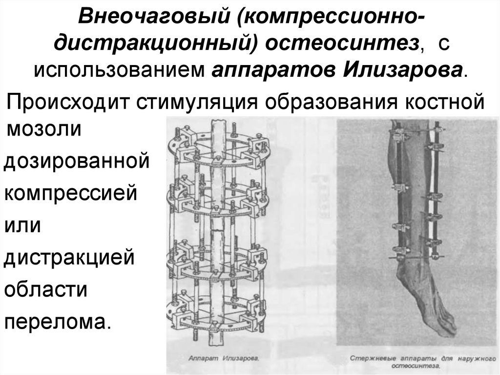 Внеочаговый остеосинтез презентация