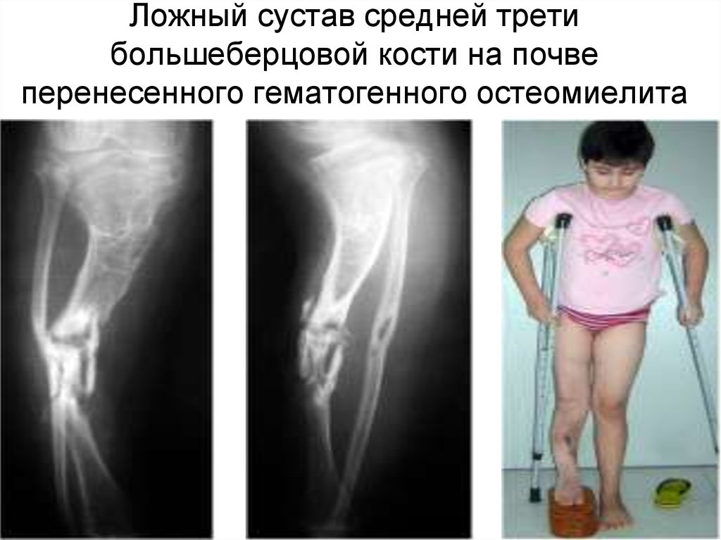 Ложный сустав средней трети большеберцовой кости на почве перенесенного гематогенного остеомиелита