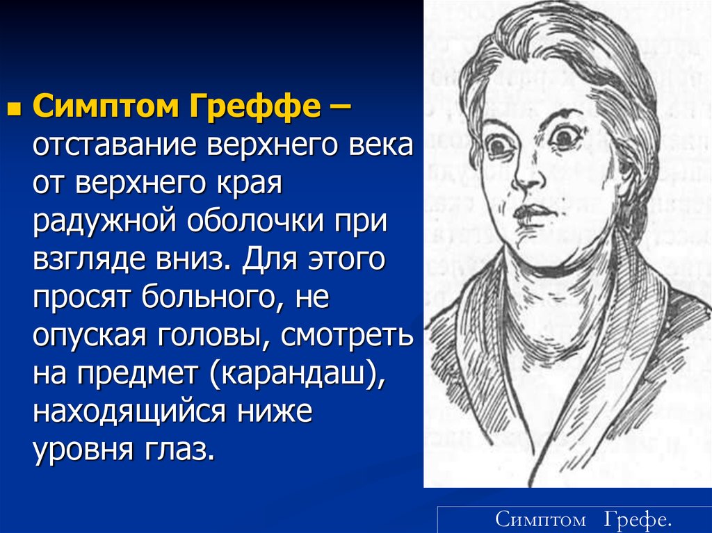 Синдром заходящего. Положительный симптом Грефе. Глазные симптомы - положительный симптом Грефе. Положительный симптом Грефе у детей.