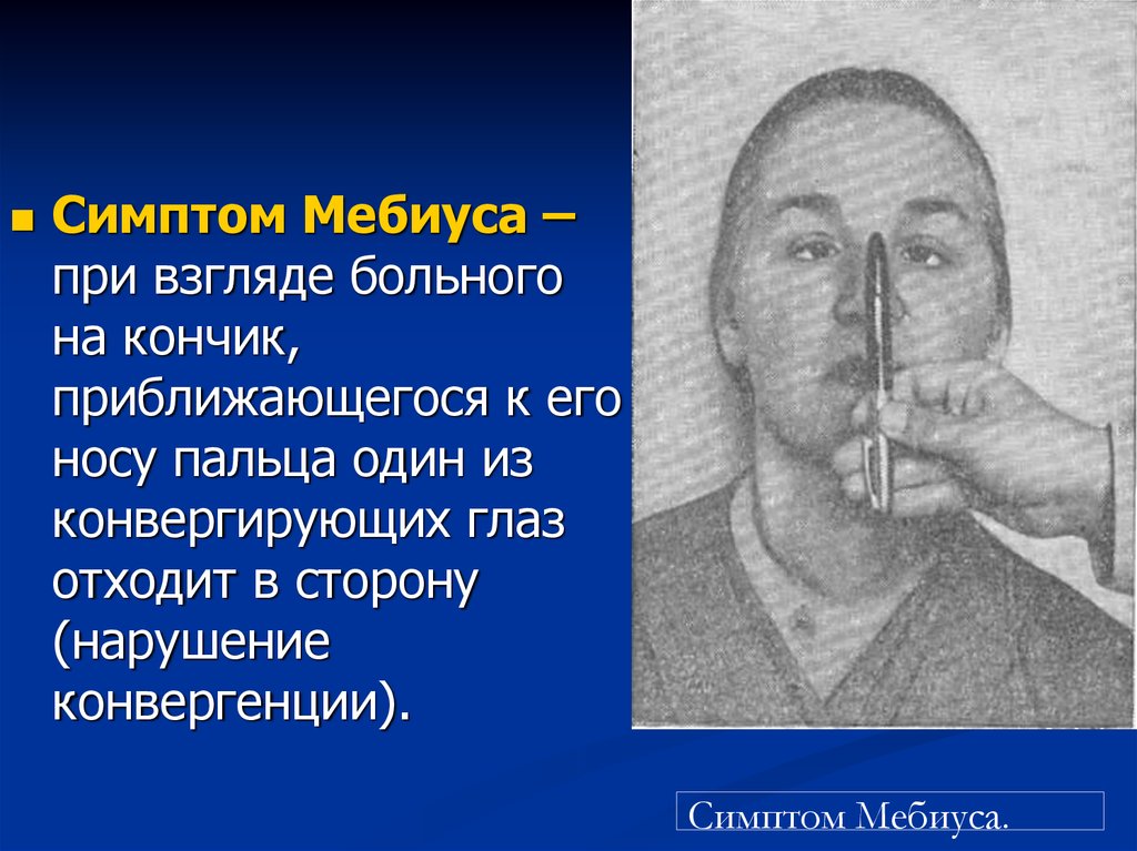 Синдром мебиуса