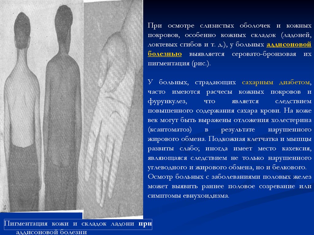 Болезнь осмотр. Пигментация ладонных складок. Осмотр кожи и слизистой оболочки. Объективный осмотр при аддисоновой болезни.