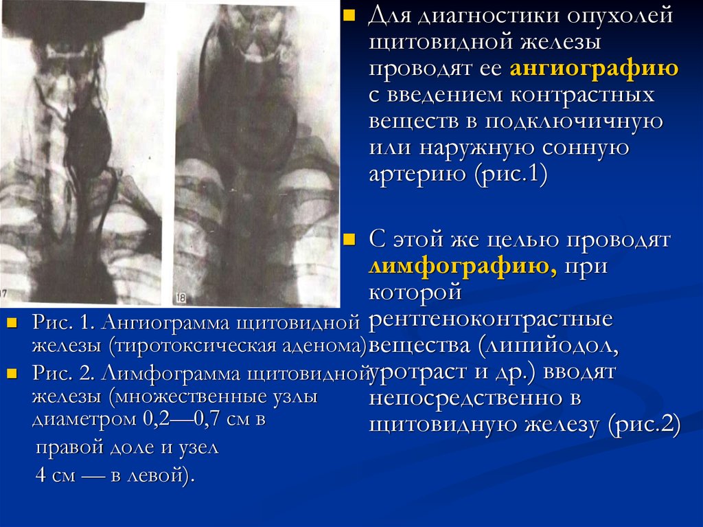 Аденома щитовидной железы. Диагноз аденома щитовидной железы. Сонография щитовидной железы. Узел в правой доле щитовидной железы.