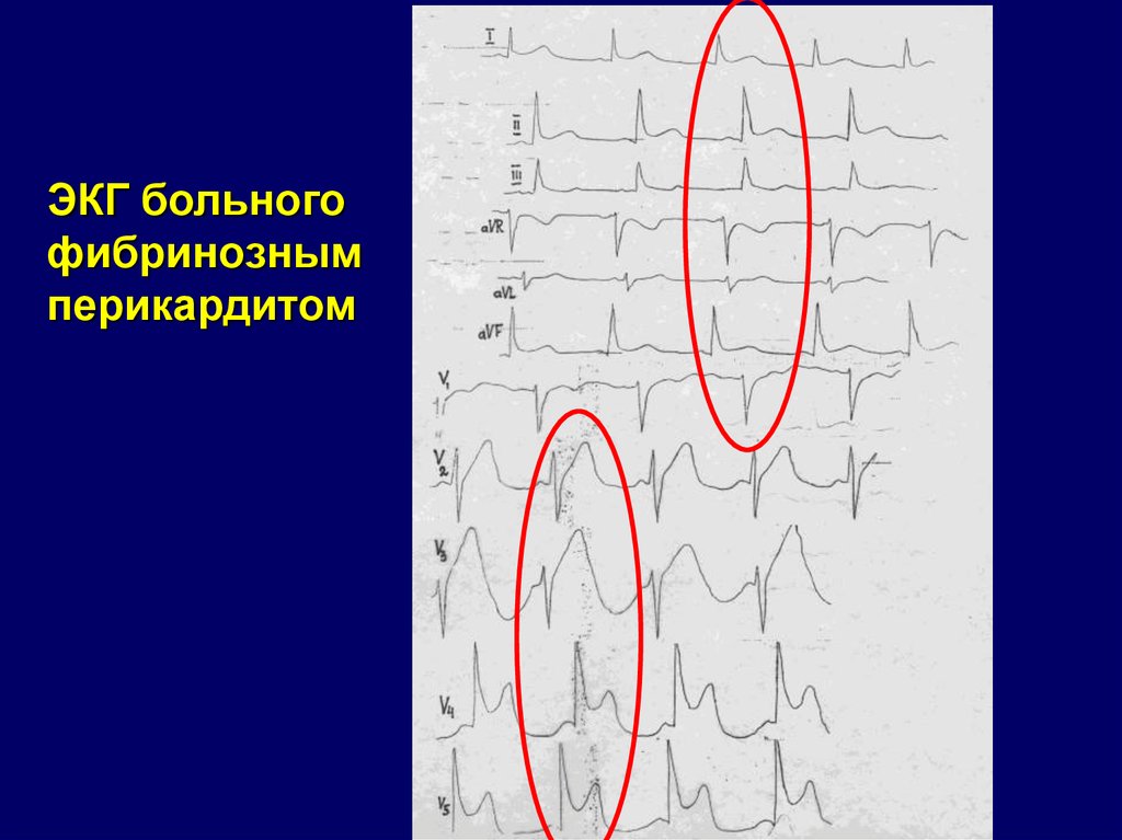 Перикардит экг картина