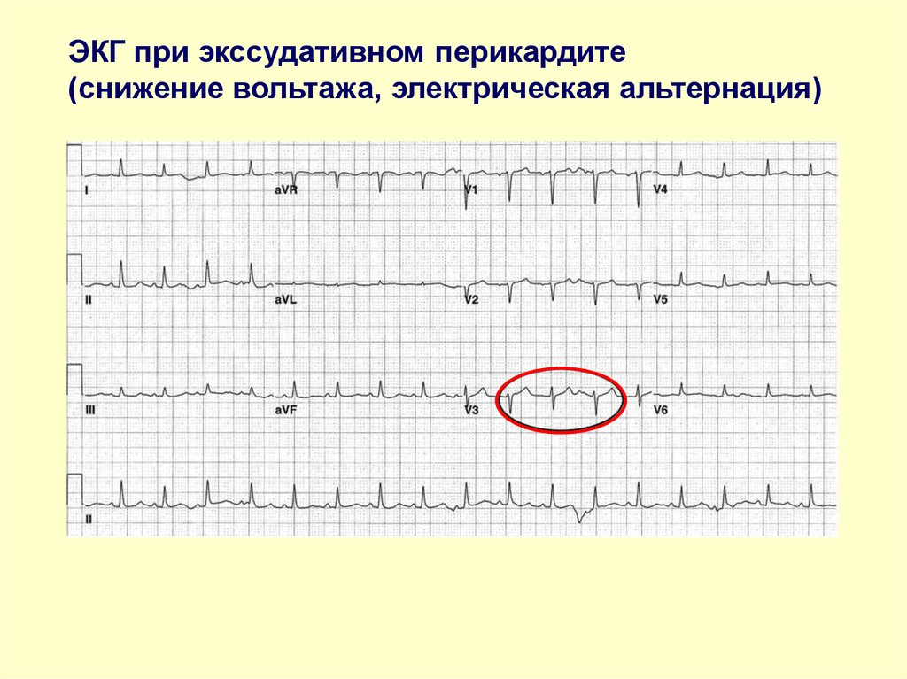 Перикардит экг картина