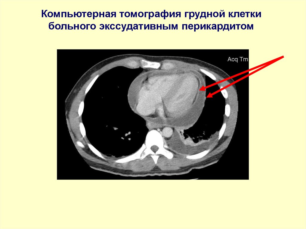 При выпотном перикардите на рентгенограмме наблюдается легочный рисунок тест ответ