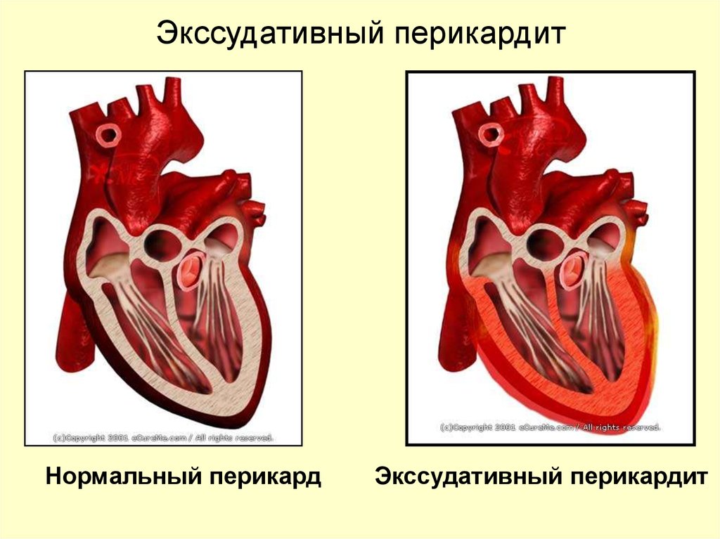 Выпотной перикардит. Хронический слипчивый перикардит. Экссудативный («выпотной») перикардит. Экссудативный периартрит.