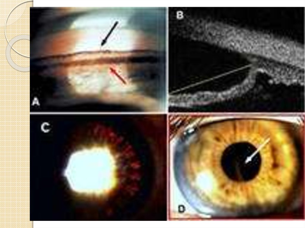 Дисперсия глаза. Пигментная открытоугольная глаукома. Неоваскулярная глаукома гониоскопия. Открытоугольная глаукома гониоскопия. Синдром пигментной дисперсии.