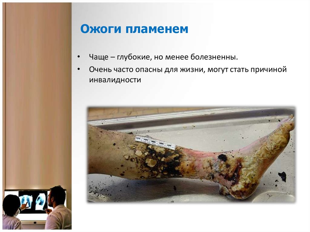 Ожоги пламенем