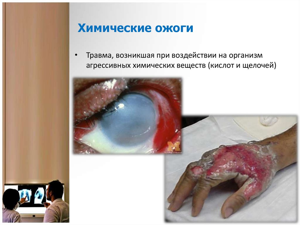 Химические ожоги