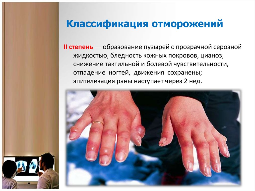 Классификация отморожений