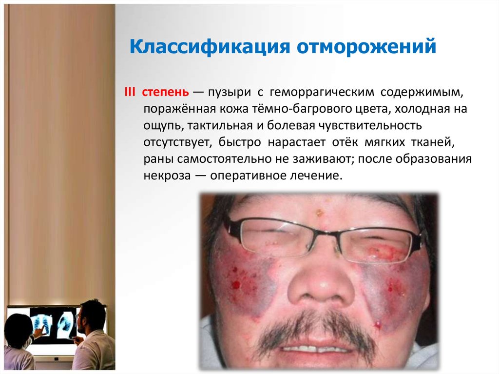 Классификация отморожений