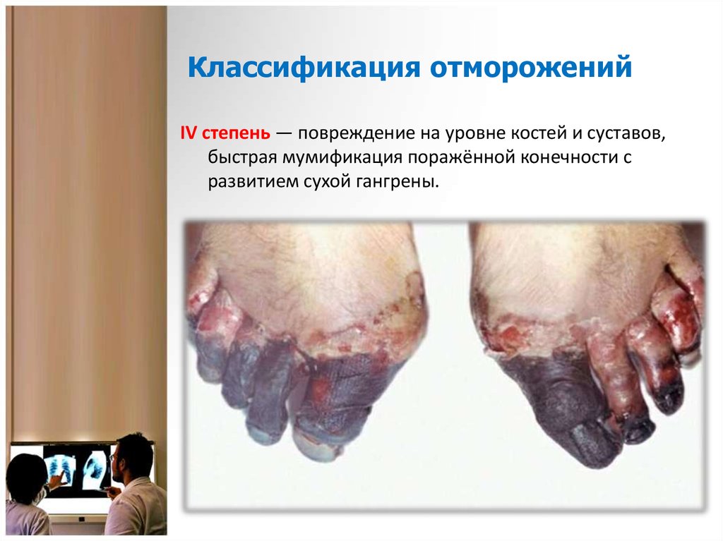 Классификация отморожений