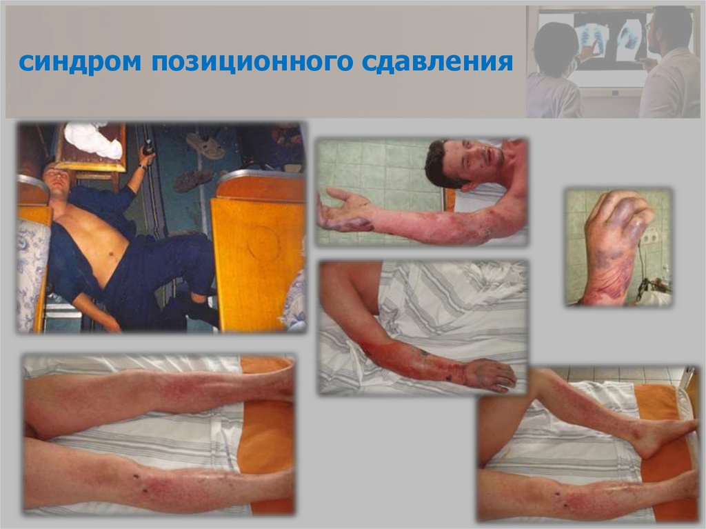 синдром позиционного сдавления