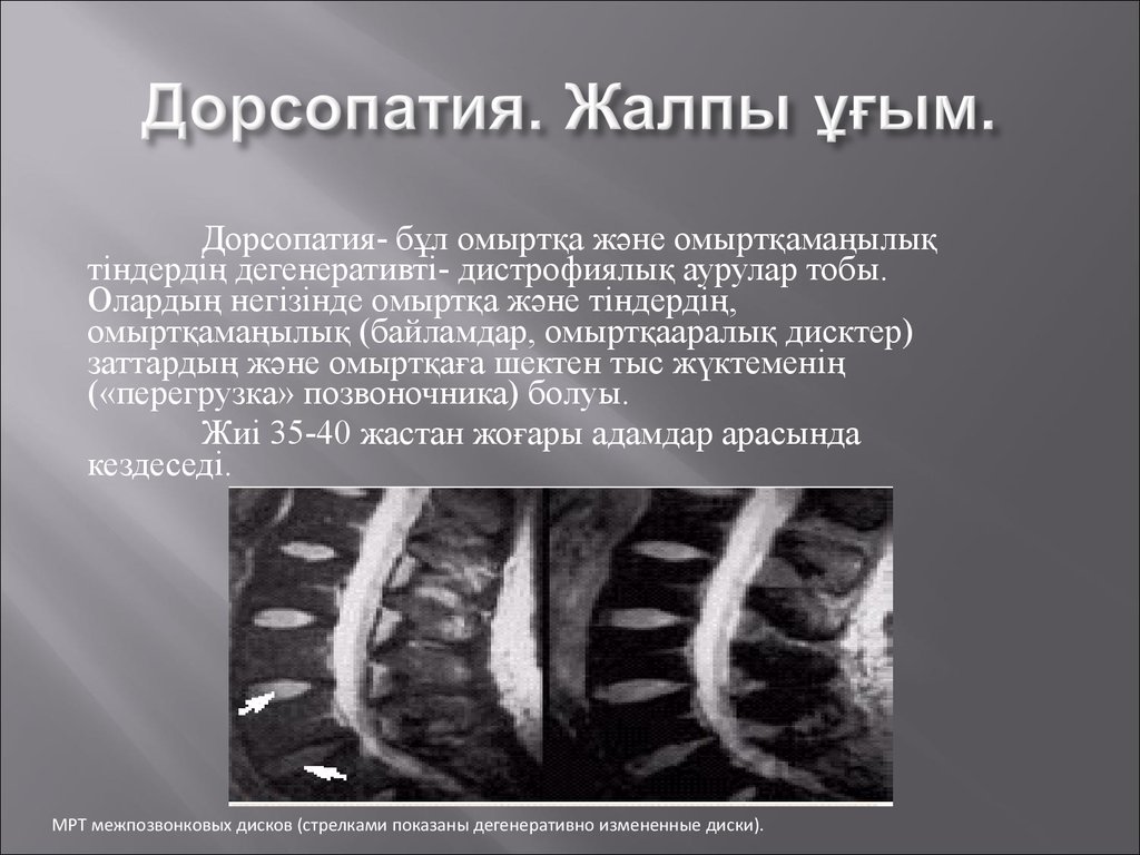 Дорсопатия поясничного отдела что это. Дорсопатии неврология. Дорсопатия позвоночника что это такое. Дорсопатия поясничного отдела позвоночника. Деформирующая дорсопатия.