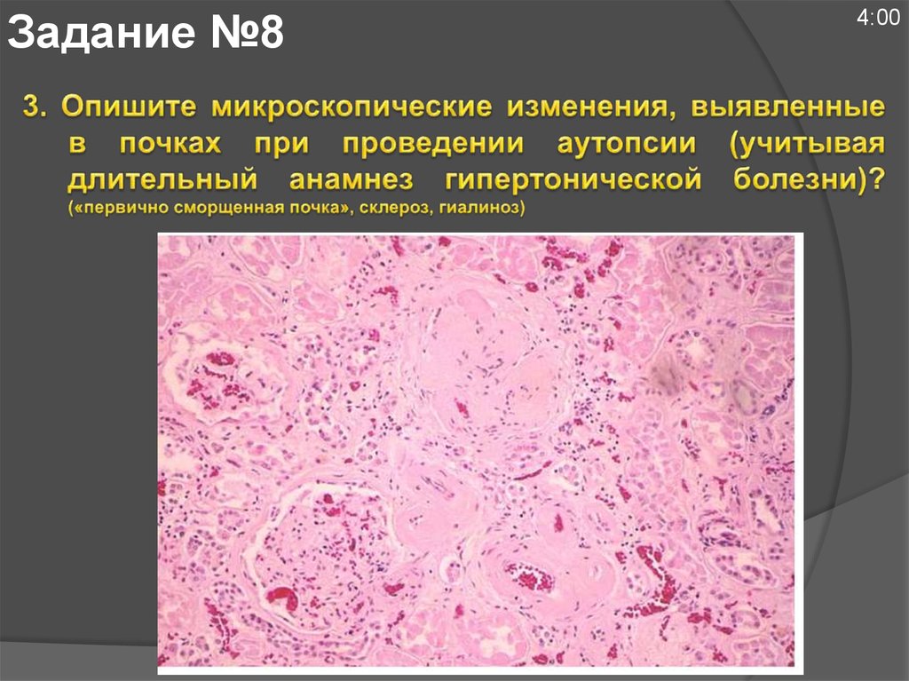 Изменение обнаружено. Почка при гипертонической болезни микропрепарат. Почка при гипертонической болезни микропрепарата. Первично-сморщенная почка при гипертонической болезни. Микроскопические изменения почек при гипертонической болезни.