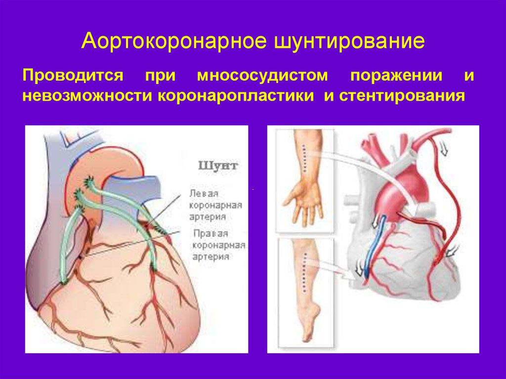 Что такое шунтирование сердца и сосудов. Операция коронарное шунтирование сосудов сердца. Схема операции аортокоронарного шунтирования. Что такое шунтирование сосудов сердца и стентирование. Аортально коронарное шунтирование.