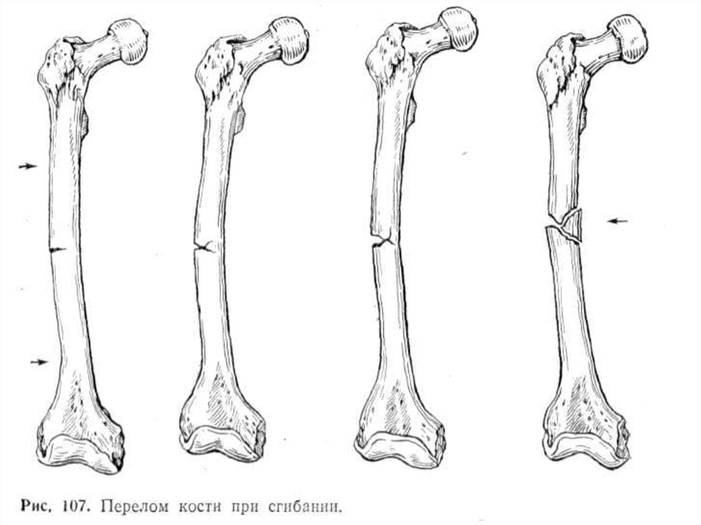 Рисунок перелома кости. Диафизарный перелом длинных костей. Метафизарный перелом плечевой кости. Диафизарный метафизарный эпифизарный перелом. Метафизарный перелом бедренной кости.