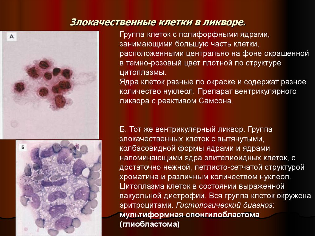 Эритроциты макрофаги. Цитология ликвора микроскопия. Лимфоциты и нейтрофилы в ликворе. Злокачественные клетки в ликворе. Плазматические клетки в ликворе.