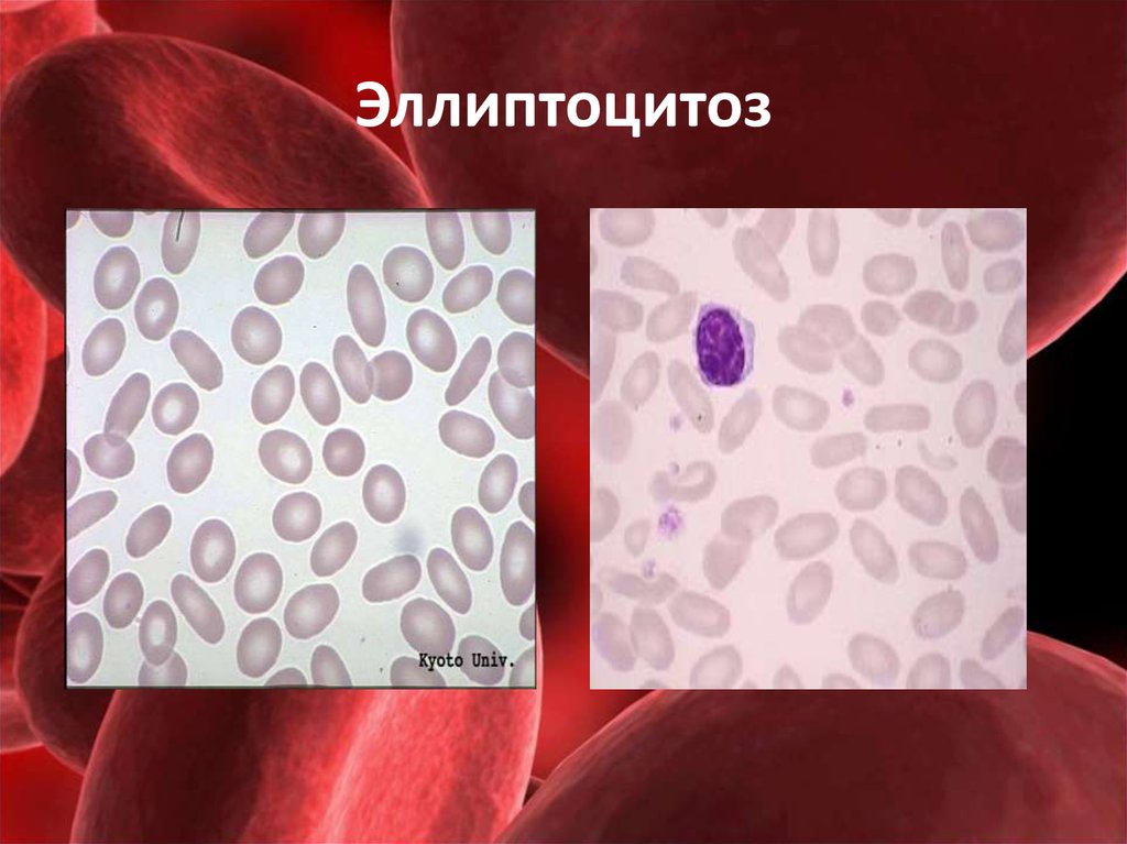 Эллиптоцитоз. Овалоцитарная анемия овалоцитоз. Наследственный эллиптоцитоз. Овалоцитарная гемолитическая анемия. Врожденный эллиптоцитоз.