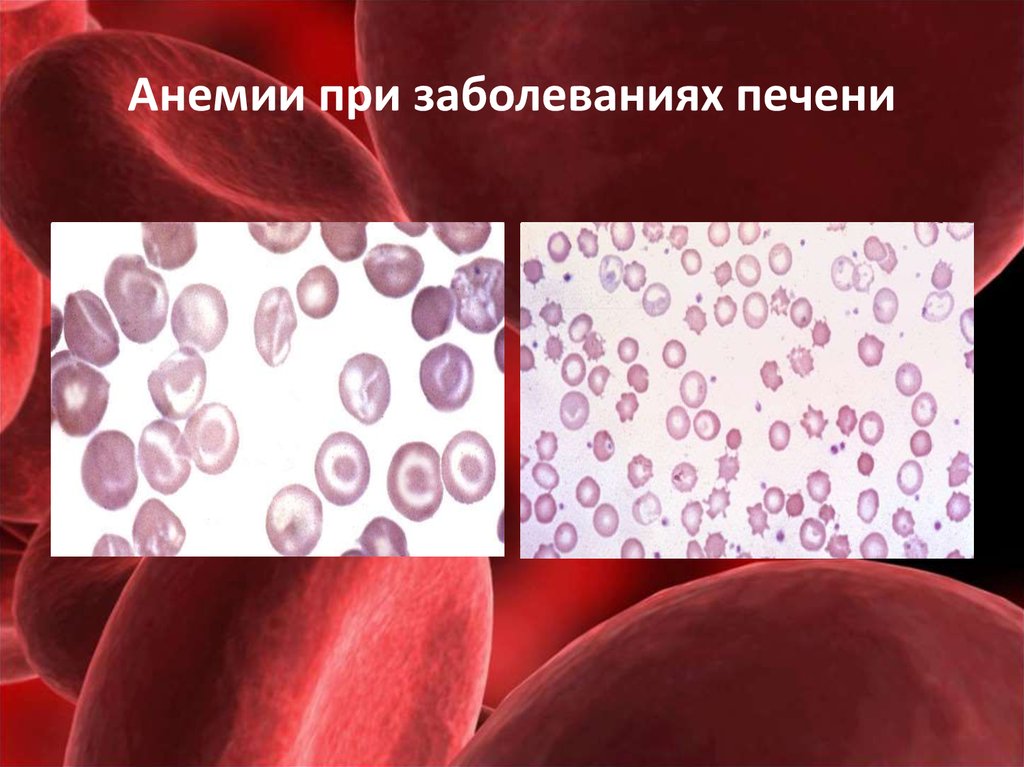 Системная анемия. Анемия при заболеваниях печени. Анемия при патологии печени.