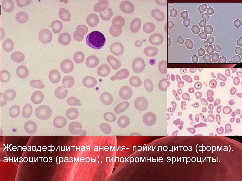 Mch анемия. Анизоцитоз пойкилоцитоз гипохромия. Пойкилоцитоз анизоцитоз анемия. Железодефицитная анемия анизоцитоз пойкилоцитоз. Анизоцитоз и пойкилоцитоз эритроцитов.