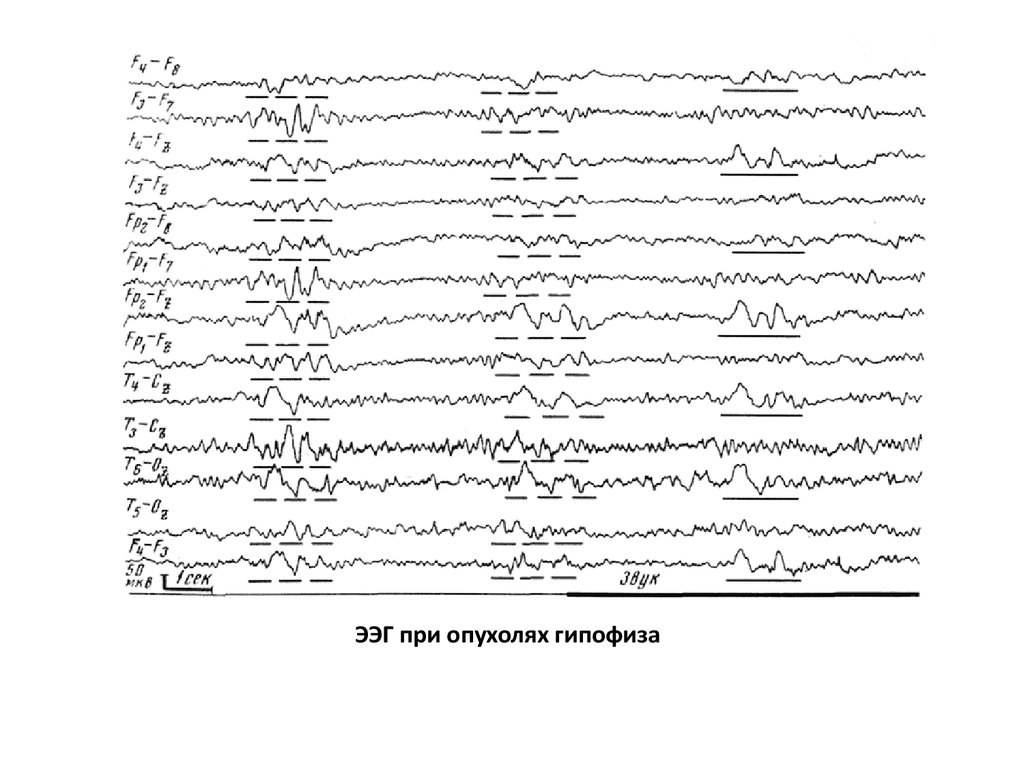 Направление на энцефалограмму образец