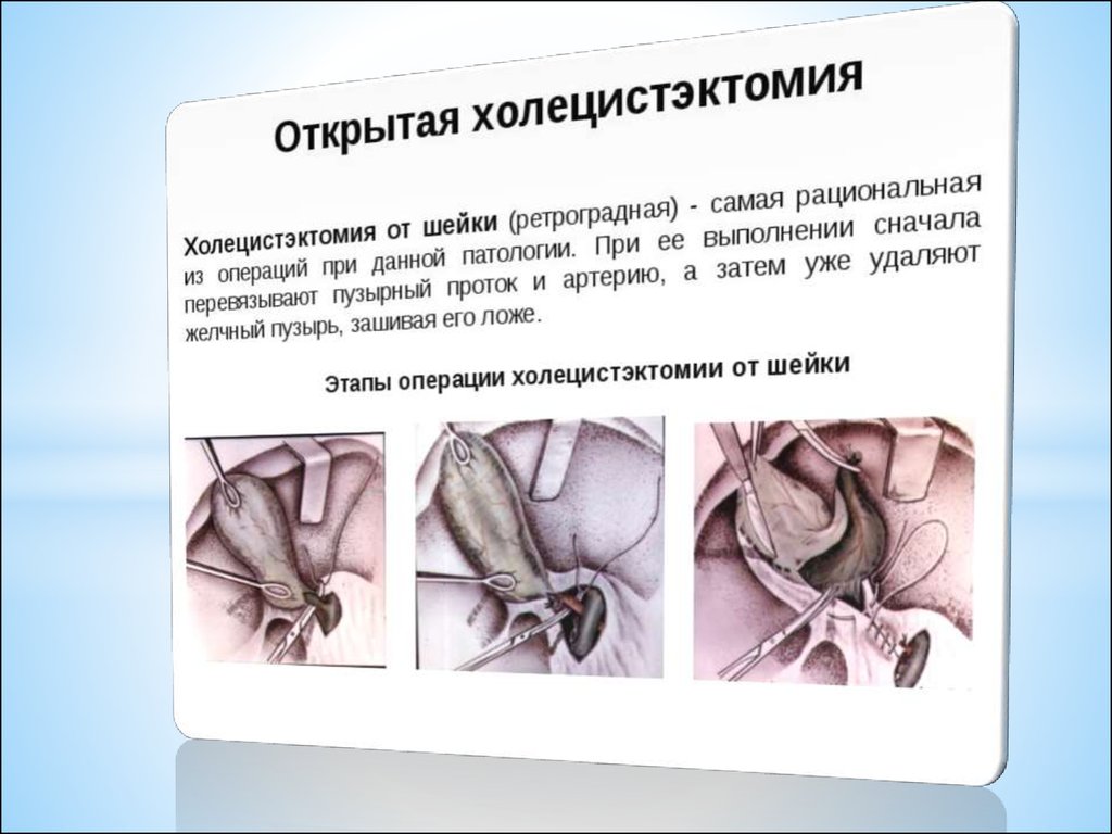 Холецистэктомия код мкб. Холецистэктомию виды 4.