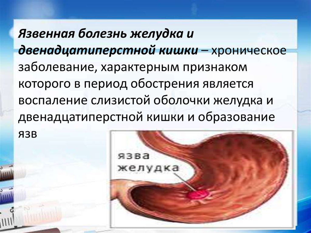 Симптомы язвенной болезни. Хроническая язвенная болезнь 12 перстной. Характерным симптомом язвы ДПК является. Язвенная болезнь болезнь желудка и 12 перстной кишки. Язвенная болезнь желудка и ДПК.