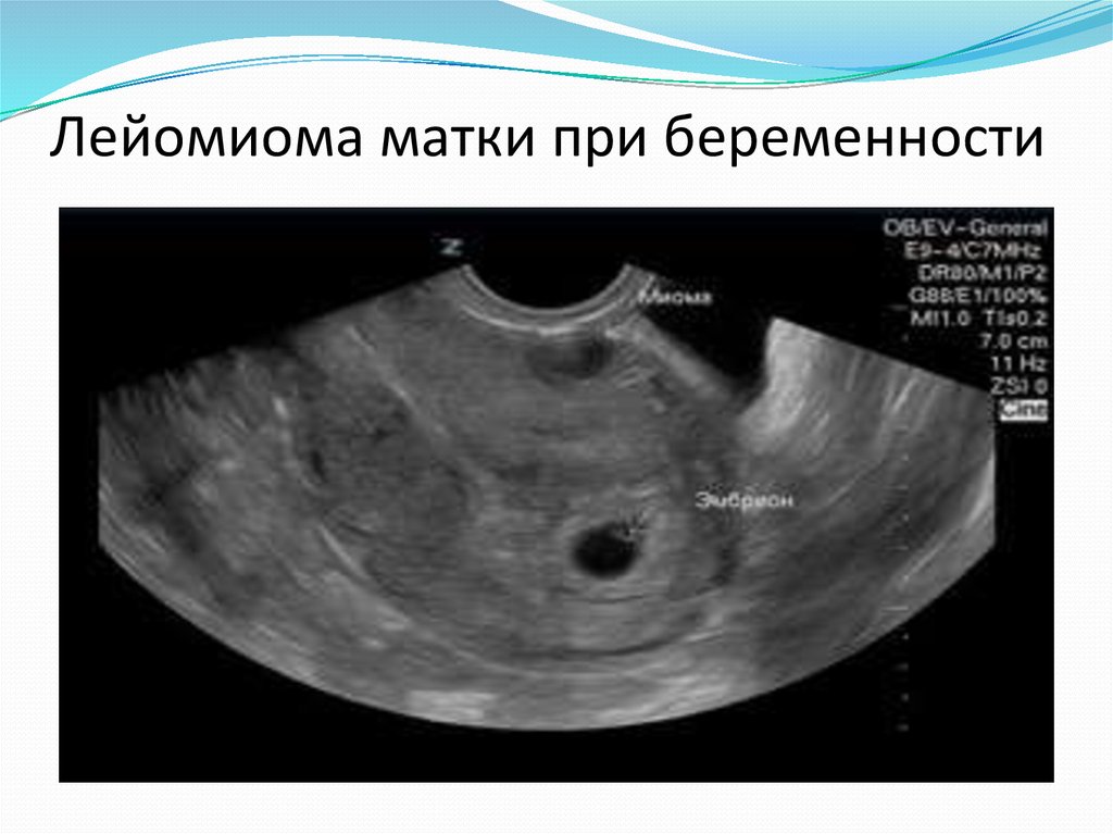 Миома матки на фото как выглядит узи фото