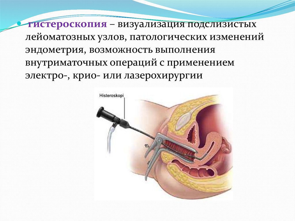 Гистероскопия ростов