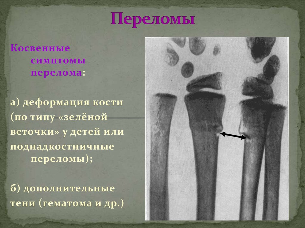 Симптомы перелома или трещины. Поднадкостничный перелом по типу зеленой веточки. Перелом по типу зеленой веточки у детей. Перелом по типу зеленой ветки большеберцовой кости. Поднадкостничный перелом.